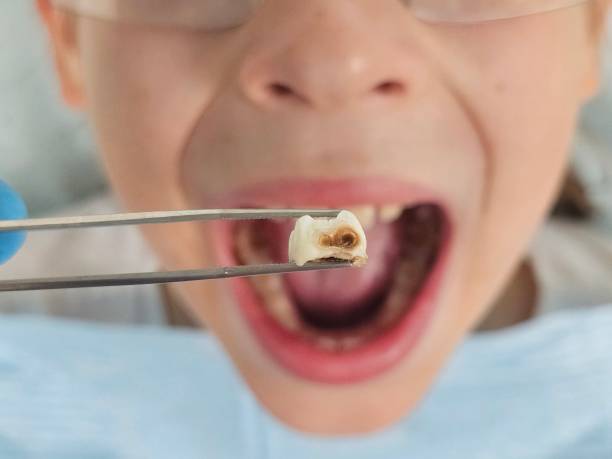 Best Emergency Tooth Extraction in Warrenton, OR